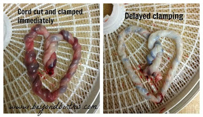cord clamping pic to show difference in blood